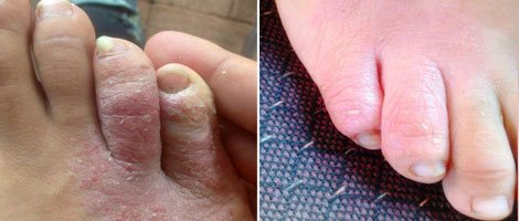 mild psoriasis on feet 