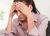 psoriasis and stress