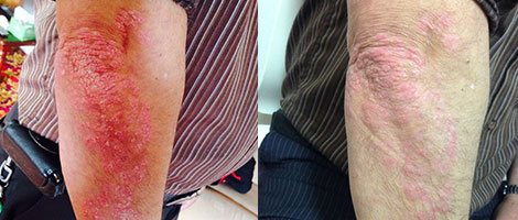 pictures of psoriasis on elbows 