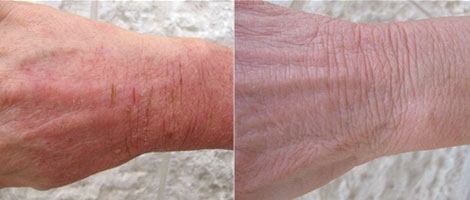 psoriasis on hands symptoms