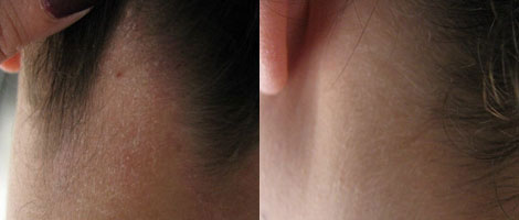 psoriasis scabs on scalp 